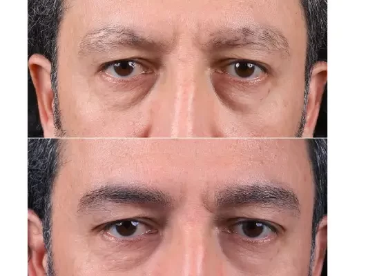 کاشت ابرو برای آقایان