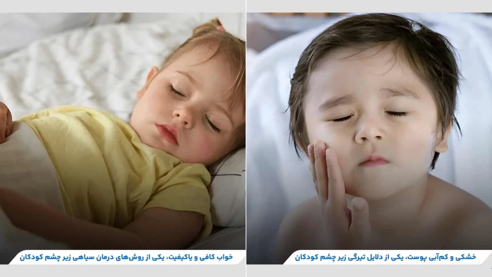 پیشگیری از تیرگی زیر چشم کودکان