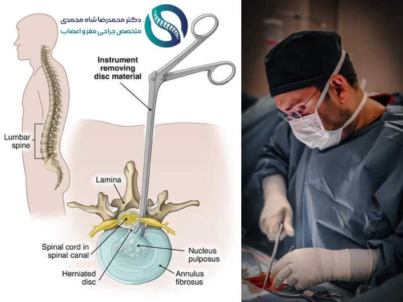 روند انجام جراحی میکروسکوپی دیسک کمر - دکتر شاه محمدی