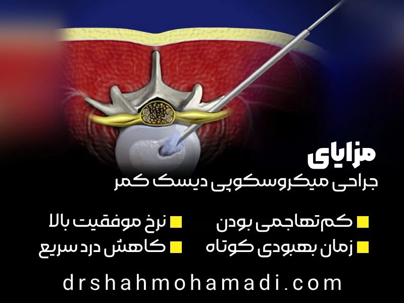 مزایای جراحی میکروسکوپی دیسک کمر - دکتر محمدرضا شاه محمدی