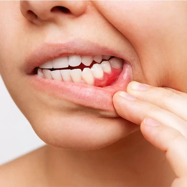 درد فک پایین و لثه به دلیل عفونت بافت لثه