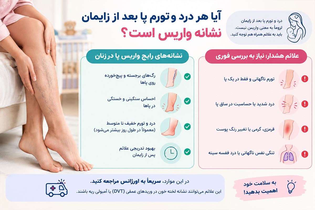 واریس بارداری