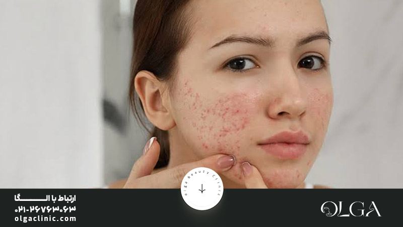 بهترین روش‌ های خانگی برای صاف شدن پوست صورت چیست؟