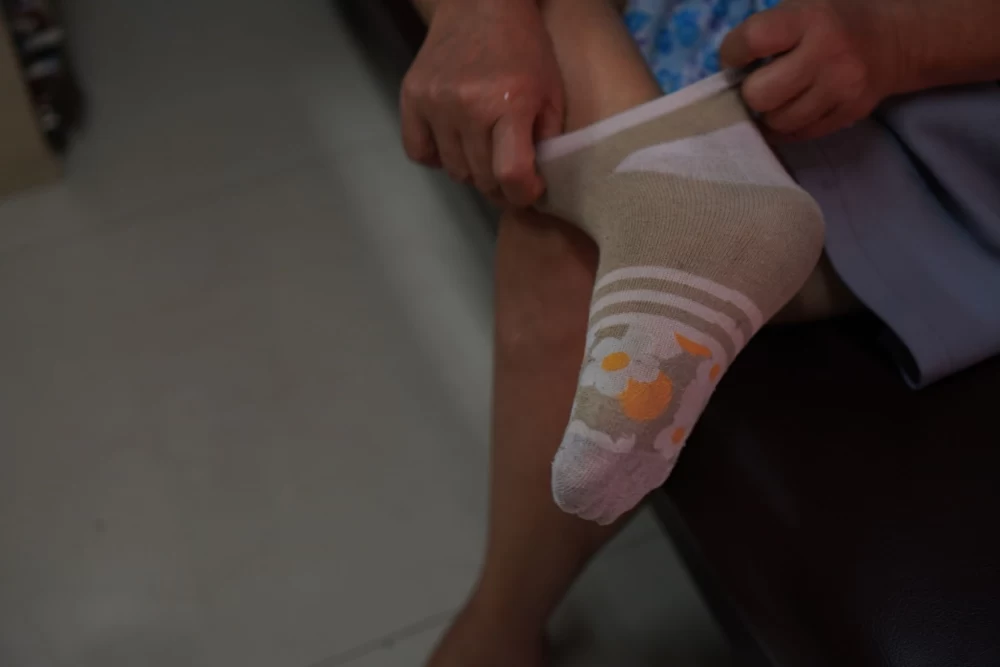 خارش جای کش جوراب