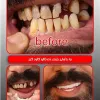 قیمت لمینت دندان دو فک اصلی برای خرابی 4 دندان...