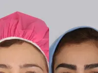 کاشت ابرو با جراحی بهتر است با بدون جراحی؛ کدام روش برای شما مناسب‌تر است؟