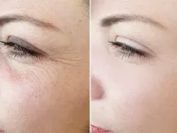 راهکارهای موثر برای جلوگیری از چروک دور چشم و لب