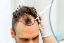 کاشت مو به روش دی اچ آی (DHI) دقت و طبیعی بودن در یک فرآیند