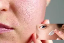 چرا بعد از زدن کرم ضد لک صورت دچار سوزش می شود ؟