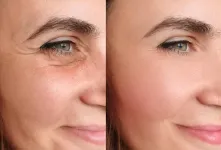 بوتاکس غیر تزریقی چیست و چه روش هایی دارد ؟