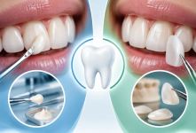تفاوت لمینت و کامپوزیت دندان؛ کدام بهتر است؟