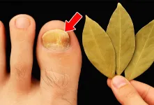 بهترین روش برای از بین بردن قارچ ناخن در خانه