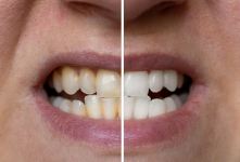 چگونه از زرد شدن و تغییر رنگ دندان ها جلوگیری کنیم؟