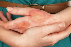سوختگی بعد از لیزر کیوسوئیچ [11 روش پیشگیری + درمان]