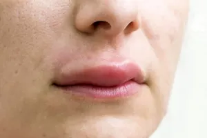 چرا چربی بعد از تزریق گلوله می‌شود؟ دلایل و راهکارها