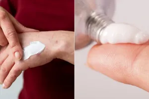 ژل سوختگی رادیوتراپی / تسکین دهنده عوارض درمانی
