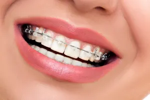 همه چیز در مورد بایت پلیت ارتودنسی !
