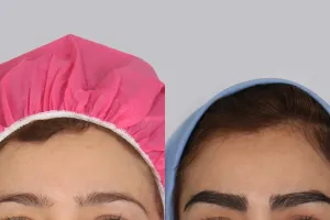 کاشت ابرو با جراحی بهتر است با بدون جراحی؛ کدام روش برای شما مناسب‌تر است؟