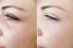 راهکارهای موثر برای جلوگیری از چروک دور چشم و لب