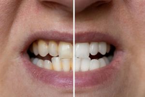 چگونه از زرد شدن و تغییر رنگ دندان ها جلوگیری کنیم؟