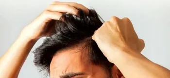 علت عقب رفتن خط رویش مو / عوامل و دلایل اصلی