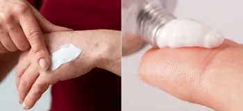 ژل سوختگی رادیوتراپی / تسکین دهنده عوارض درمانی
