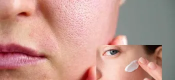 چرا بعد از زدن کرم ضد لک صورت دچار سوزش می شود ؟