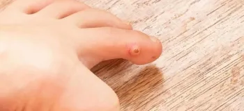 کرایوتراپی میخچه / درمانی پیشرفته برای رفع مشکلات پوستی