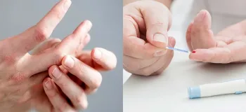 بررسی تاثیر دیابت بر مفاصل و استخوان ها
