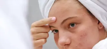 آکنه کومدونال / از علل تا روش های درمان این عارضه ی پوست