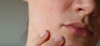 بررسی تاثیرات هورمون ها بر سلامت و زیبایی پوست