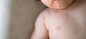 راهکارهای سریع برای بهبود و ترمیم جای زخم نوزاد