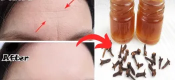 نحوه ساخت بوتاکس طبیعی با میخک / تا ۱۰ سال جوان تر از سن خود به نظر برسید