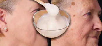 روش طبیعی برای از بین بردن لک های صورت در میانسالی / لیفت طبیعی صورت با کلاژن