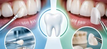 تفاوت لمینت و کامپوزیت دندان؛ کدام بهتر است؟