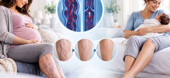 آیا واریس پا بعد از زایمان خوب می شود؟