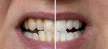 چگونه از زرد شدن و تغییر رنگ دندان ها جلوگیری کنیم؟