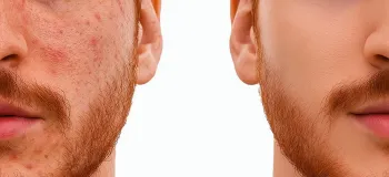 فقط ۶ دقیقه وقت بده تا پوستتو نجات بدم!