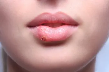 علت ایجاد تبخال بعد از تزریق ژل لب