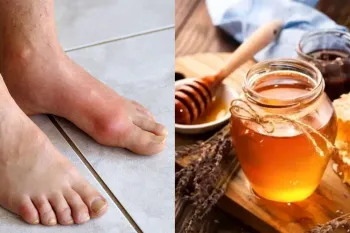 تاثیر عسل بر درمان نقرس / خواص و روش های مصرف