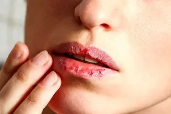 راهکارهای بهبود خشکی لب ناشی از بیهوشی و لوله تنفسی
