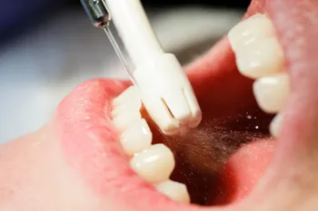 مزایای عالی بروساژ دندان و روش های انجام آن