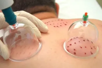 بهترین روزهای حجامت در سال ۱۴۰۵؛ تقویم کامل ایام قمری برای حجامت