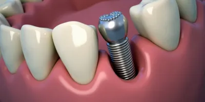 مراحل و نکات مهم