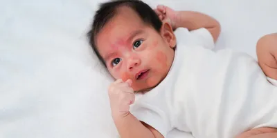 علائم حساسیت به