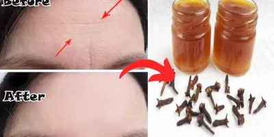 نحوه ساخت بوتاکس