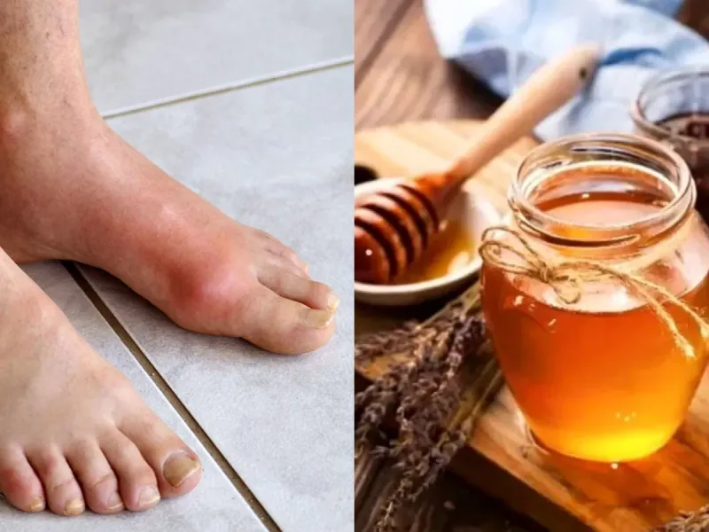 تاثیر عسل بر درمان نقرس / خواص و روش های مصرف