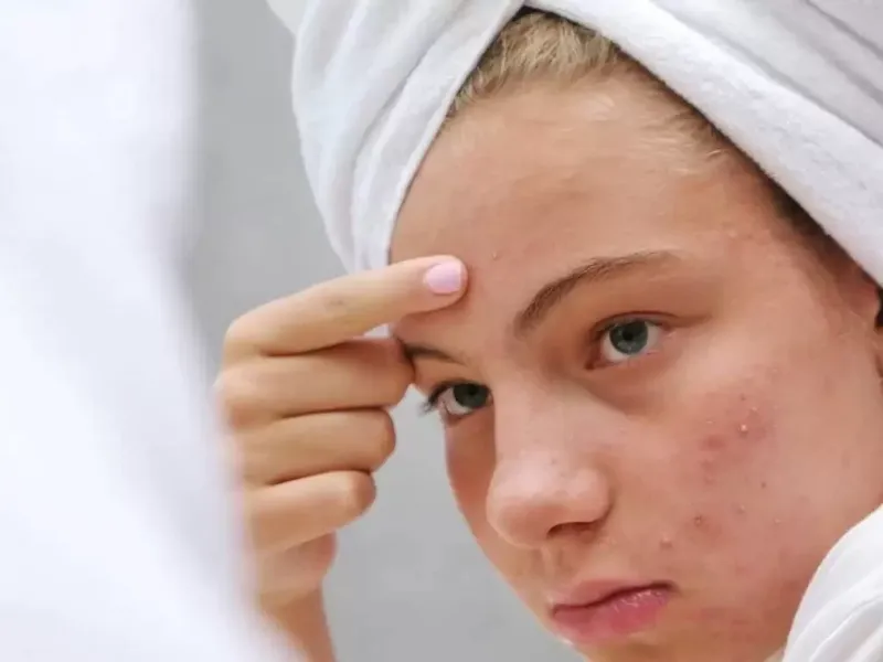 آکنه کومدونال / از علل تا روش های درمان این عارضه ی پوست