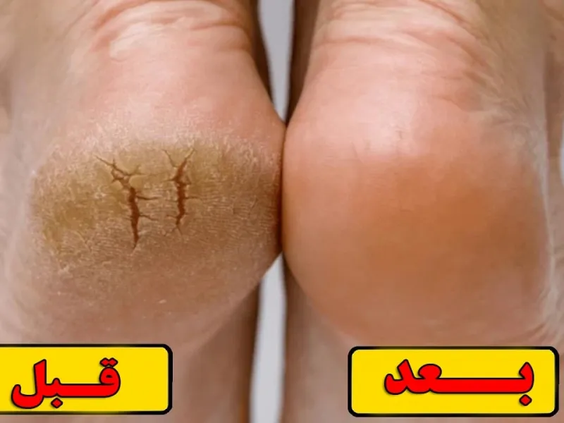 روشی طبیعی برای از بین بردن ترک کف پا در خانه در یک جلسه